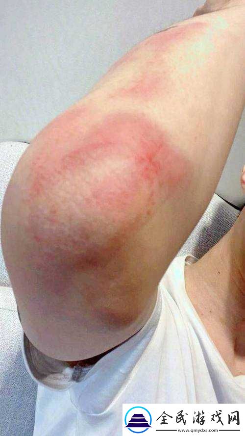 红肿疼痛小缝不能合拢：这是怎么了