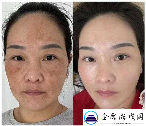 国产-377vc-精华-2-真能祛斑吗：效果究竟如何