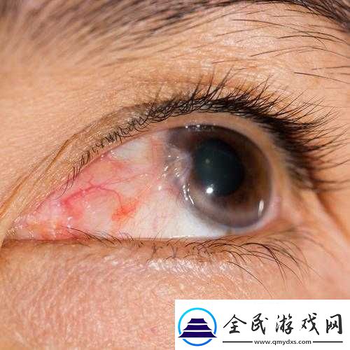 超级胬肉系统：一种新的医学发现